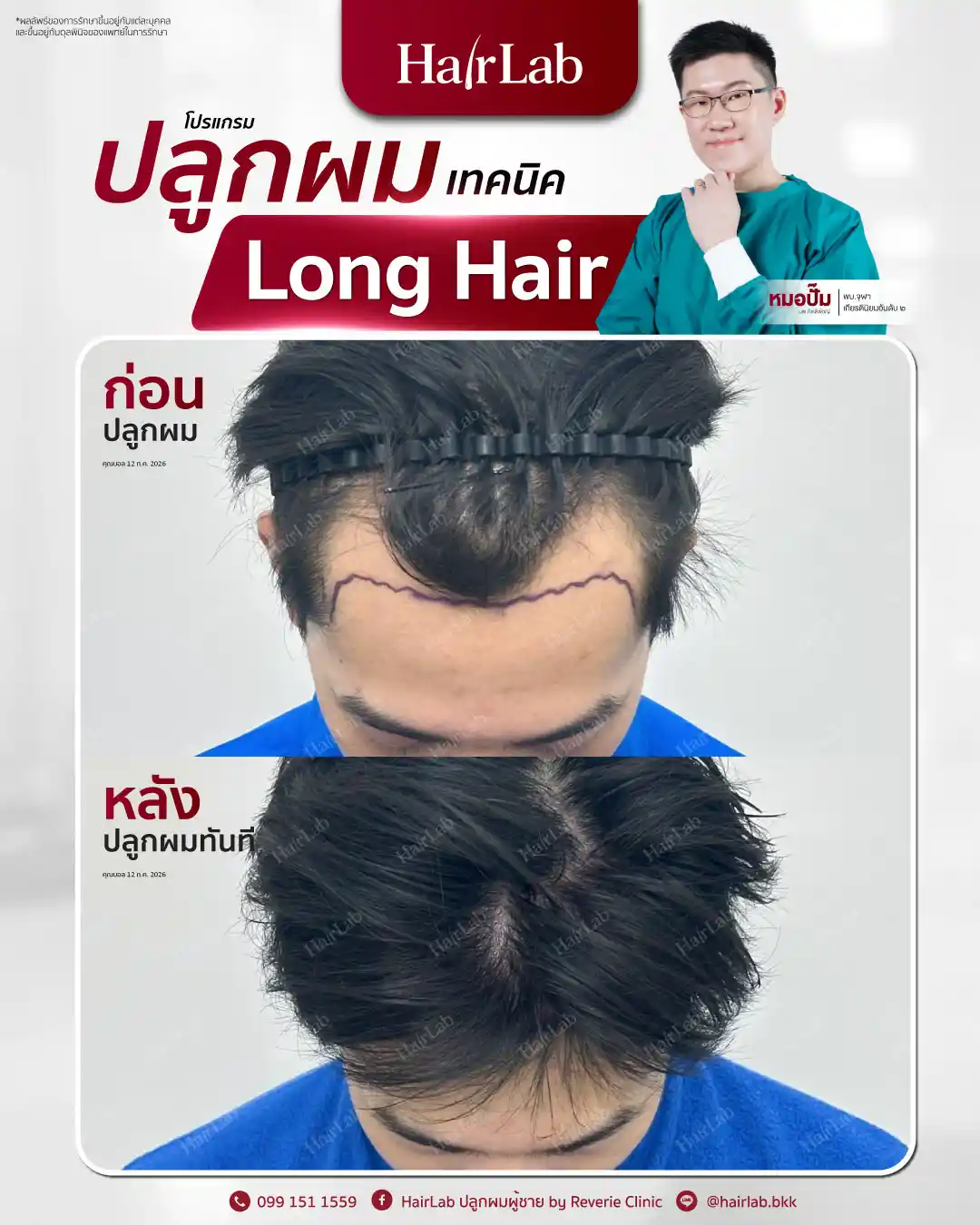 ก่อน-หลังปลูกผมเทคนิค Long Hair-25