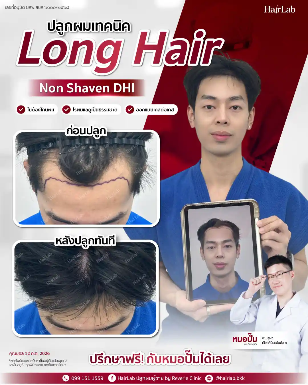 ก่อน-หลังปลูกผมเทคนิค Long Hair-26