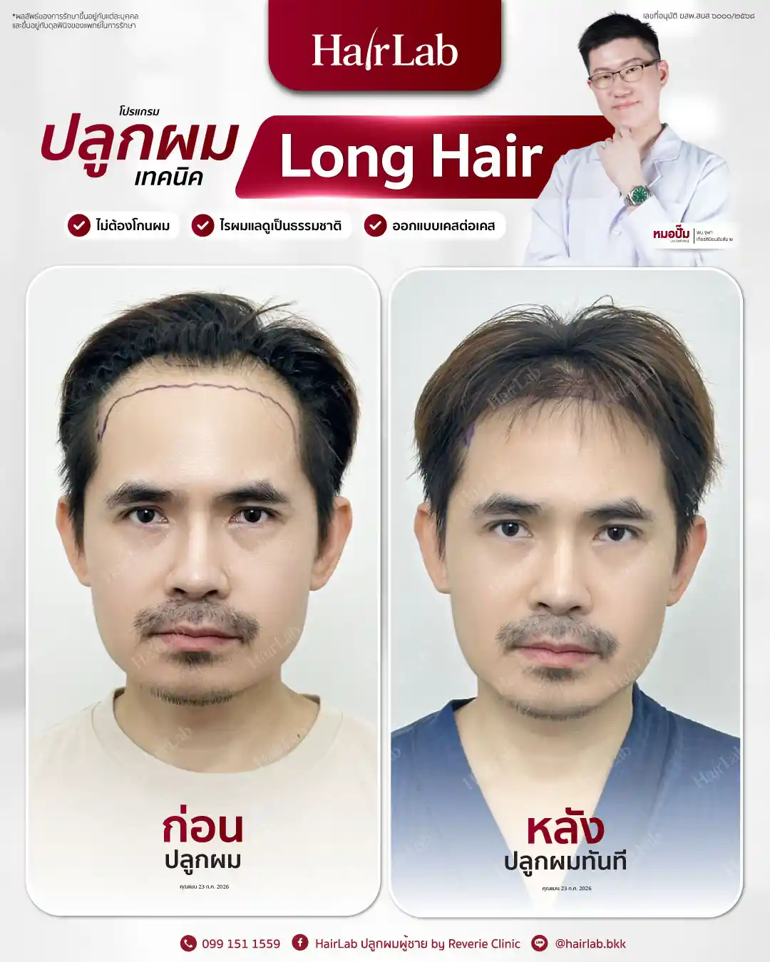 ก่อน-หลังปลูกผมเทคนิค Long Hair-27