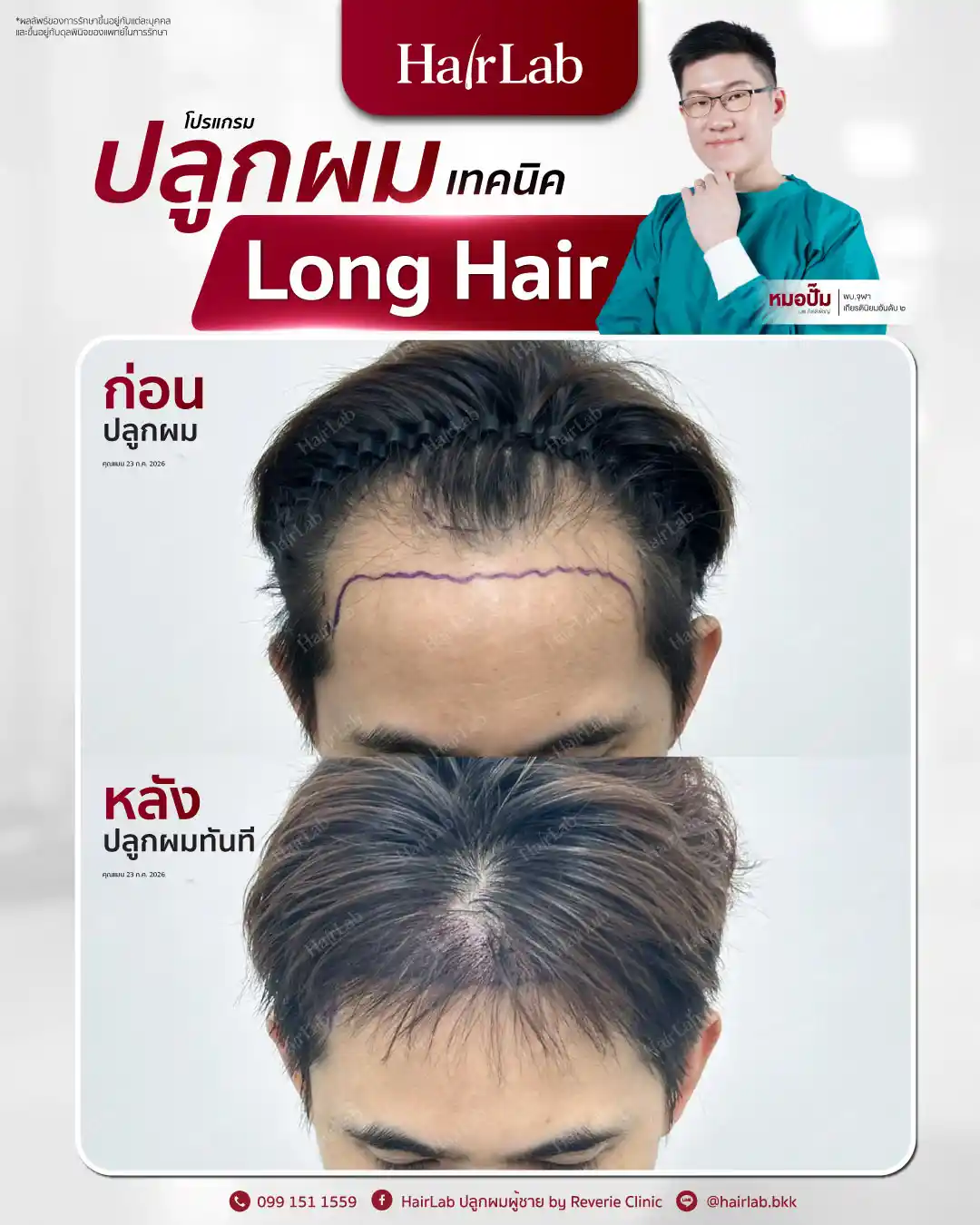 ก่อน-หลังปลูกผมเทคนิค Long Hair-28