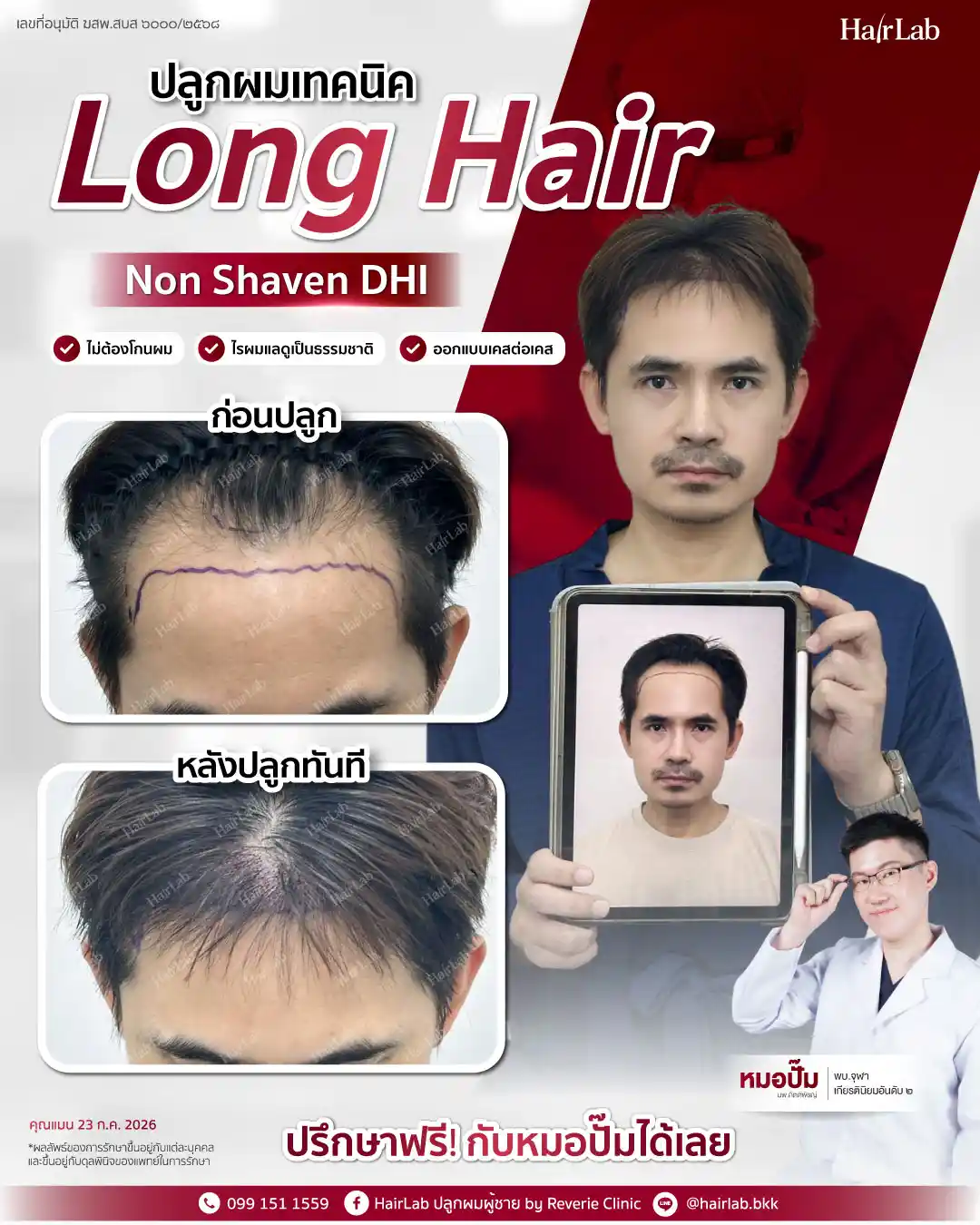 ก่อน-หลังปลูกผมเทคนิค Long Hair-29