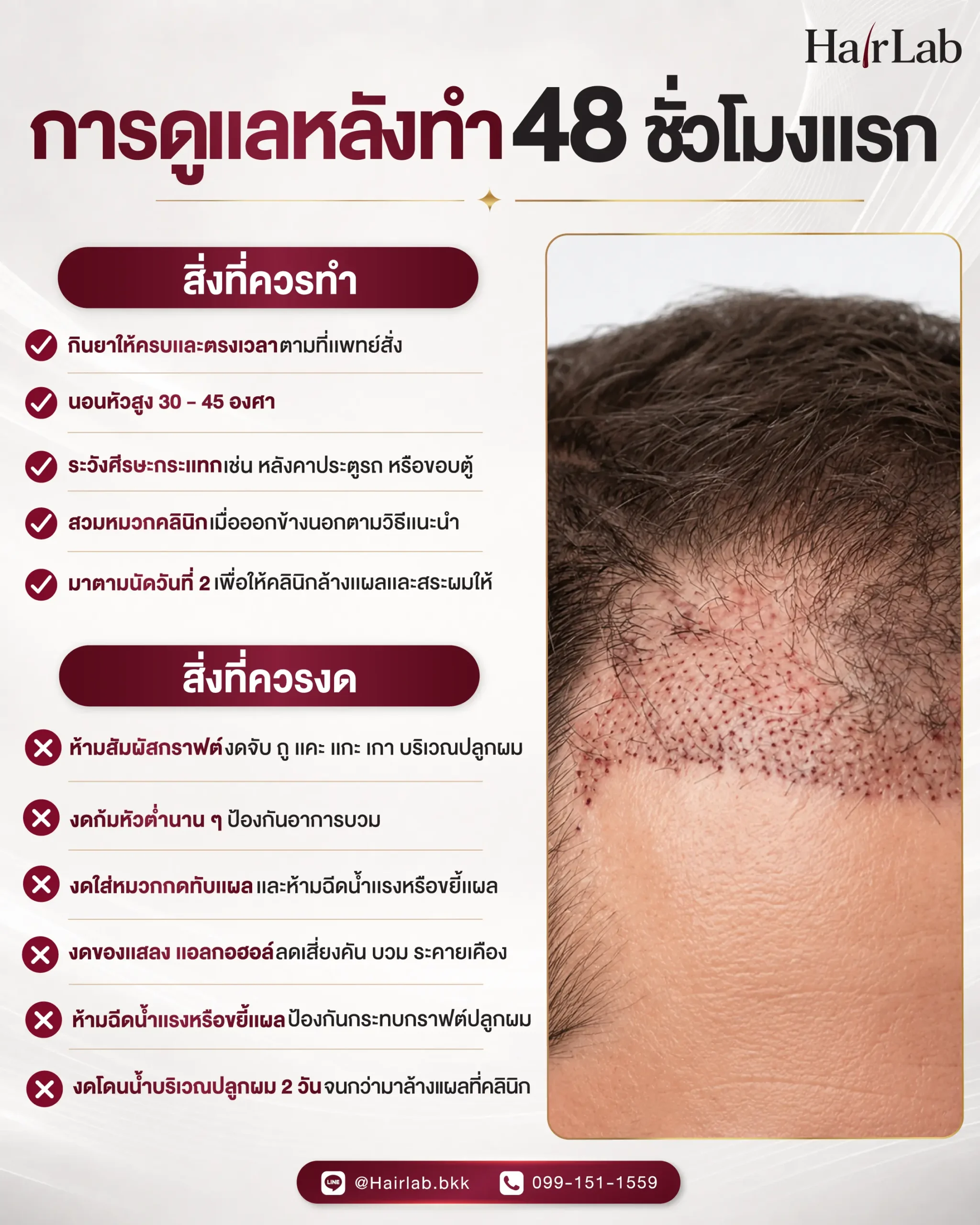 การดูแลเส้นผมในช่วง 48 ชั่วโมงแรกหลังปลูกผม