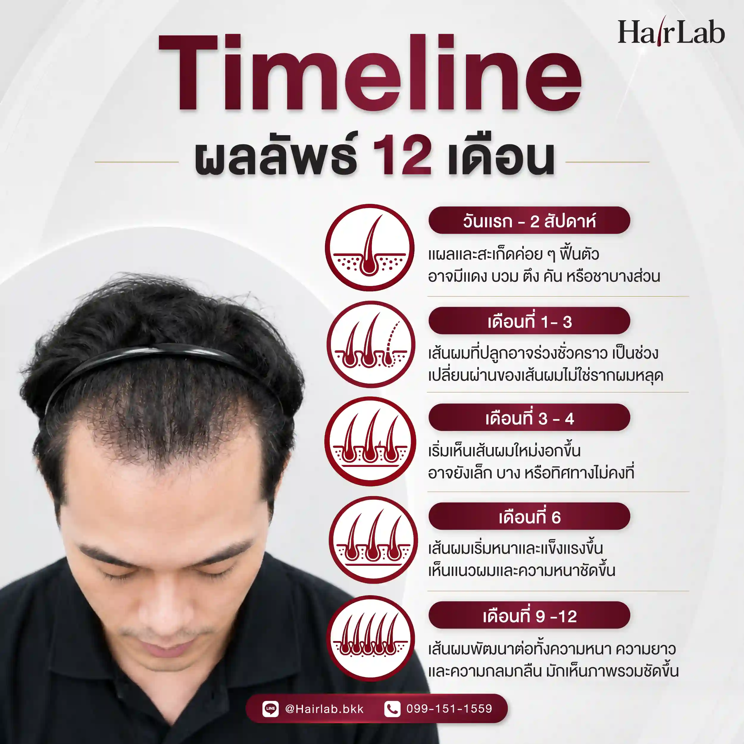 ไทม์ไลน์ผลลัพธ์การปลูกผม 12 เดือน HairLab