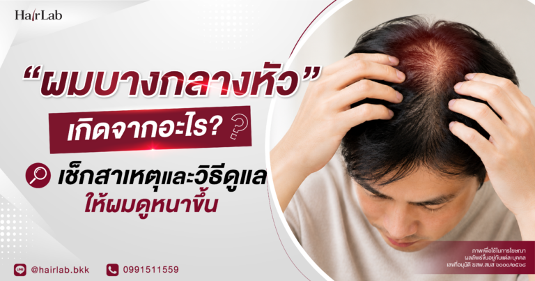 “ผมบางกลางหัว” เกิดจากอะไร? เช็กสาเหตุและวิธีดูแลให้ผมดูหนาขึ้น