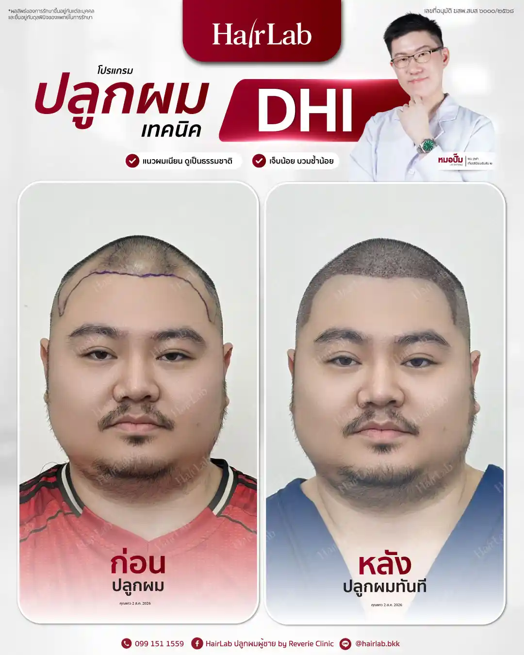 ก่อน-หลังปลูกผมเทคนิค DHI-28