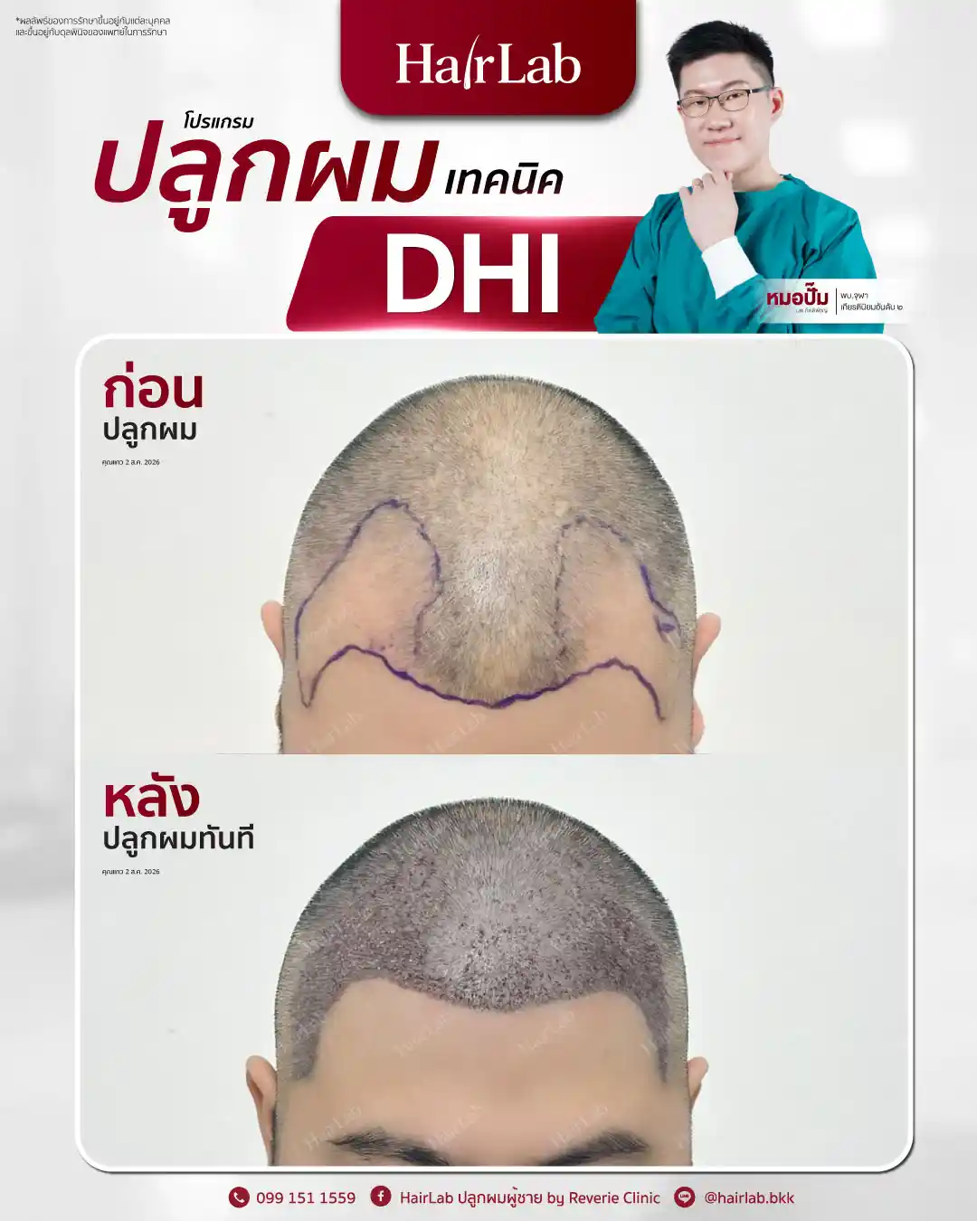 ก่อน-หลังปลูกผมเทคนิค DHI-29
