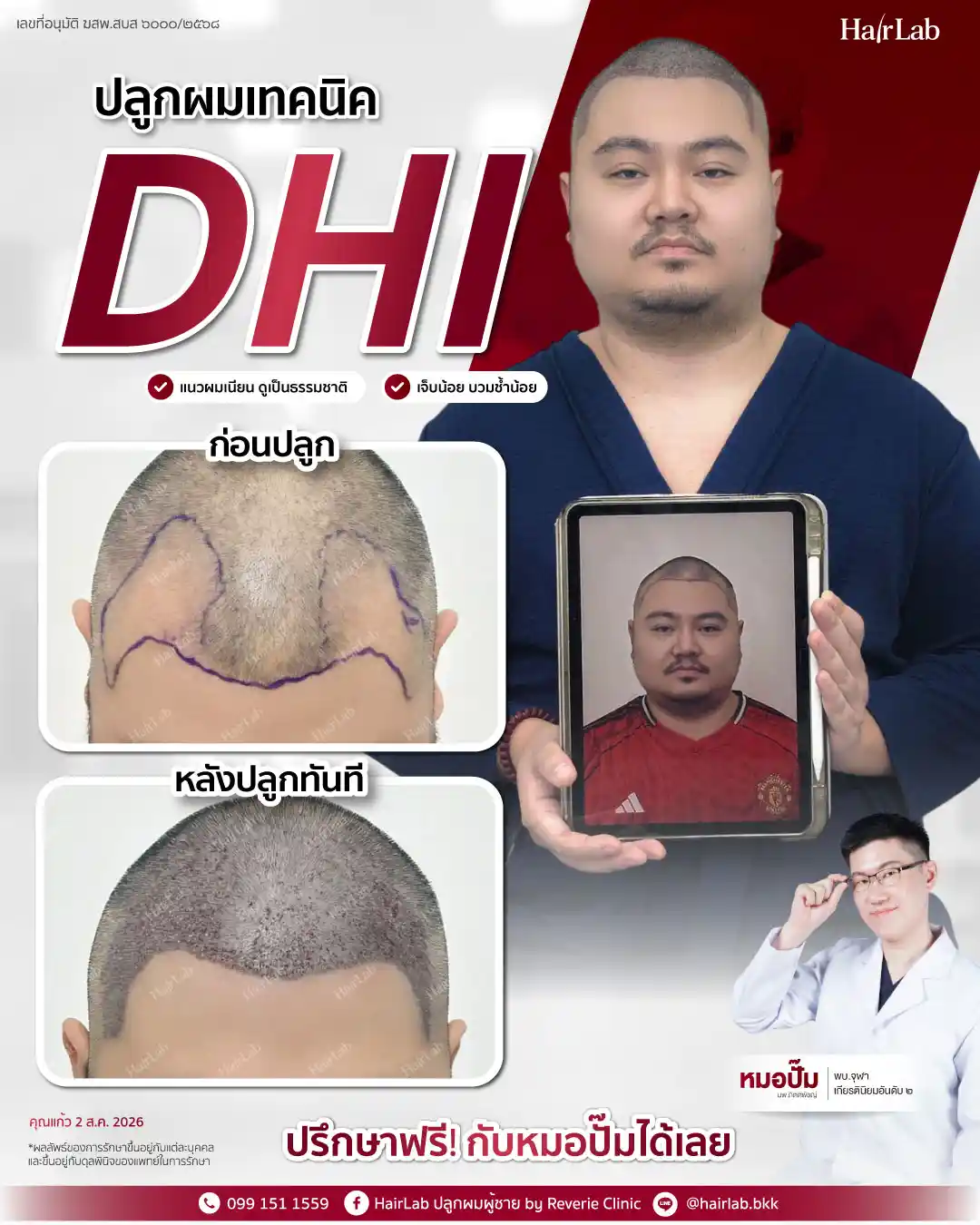 ก่อน-หลังปลูกผมเทคนิค DHI-30