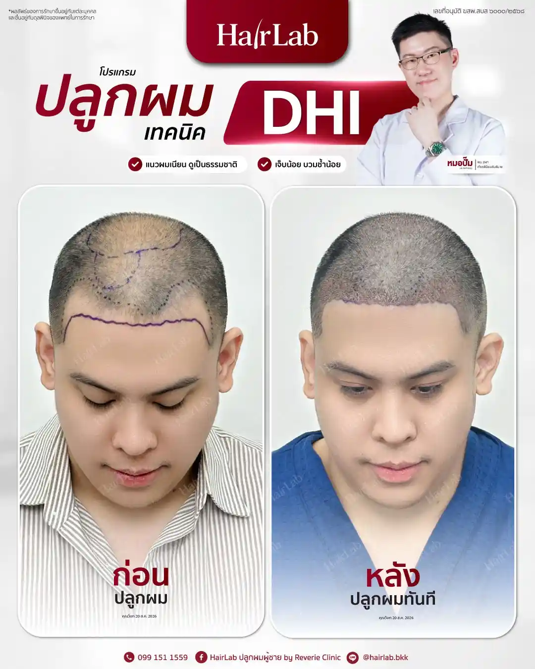 ก่อน-หลังปลูกผมเทคนิค DHI-31