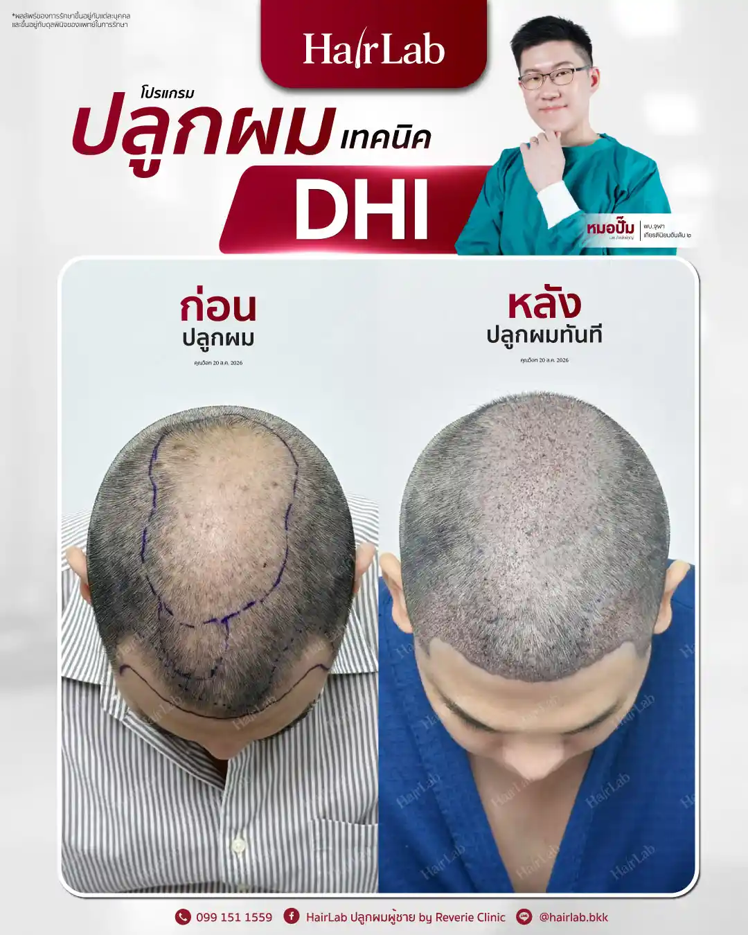 ก่อน-หลังปลูกผมเทคนิค DHI-32