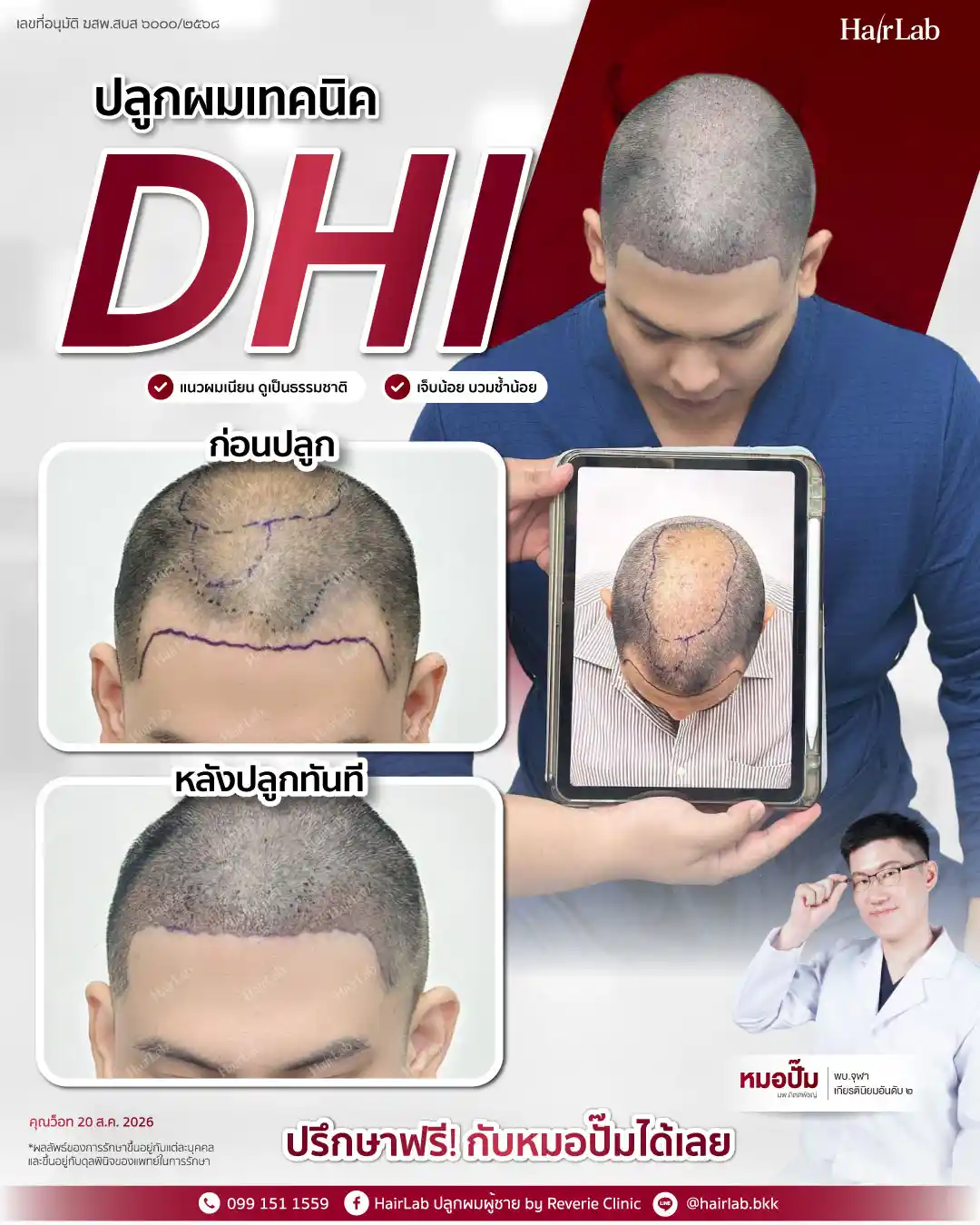 ก่อน-หลังปลูกผมเทคนิค DHI-33