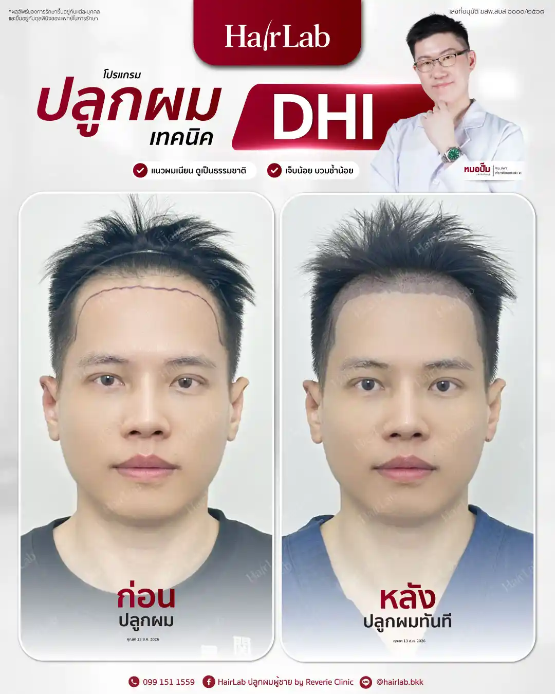 ก่อน-หลังปลูกผมเทคนิค DHI-34