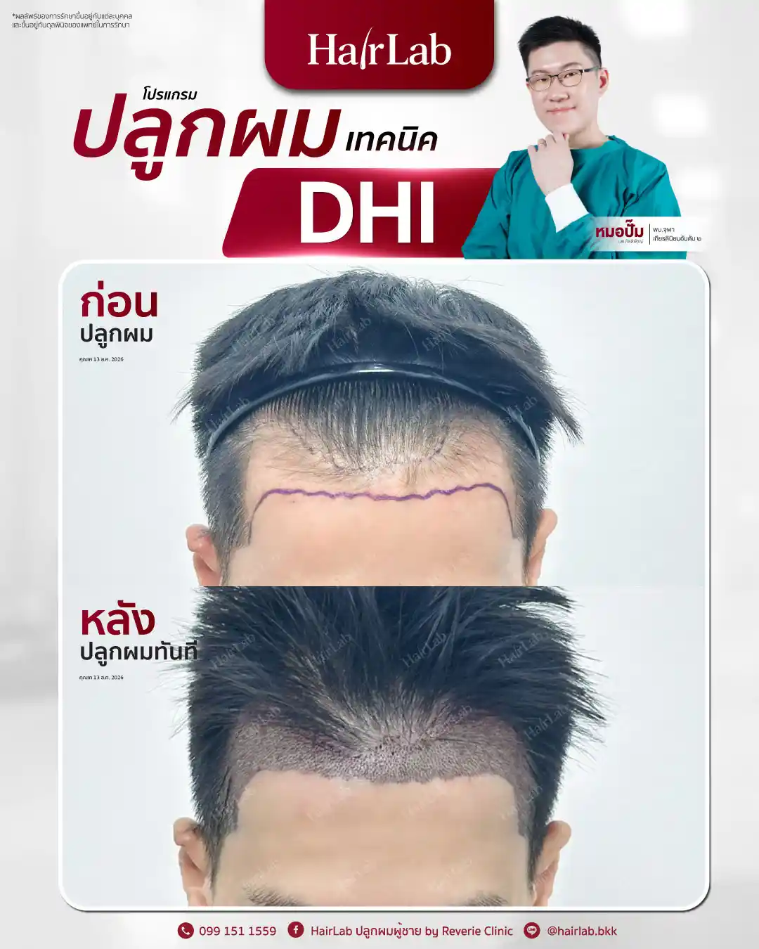 ก่อน-หลังปลูกผมเทคนิค DHI-35
