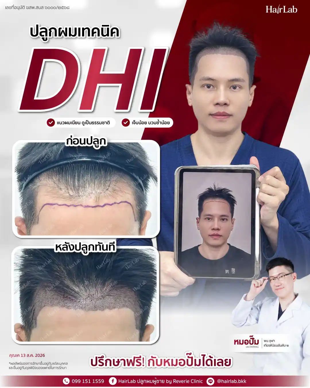 ก่อน-หลังปลูกผมเทคนิค DHI-36