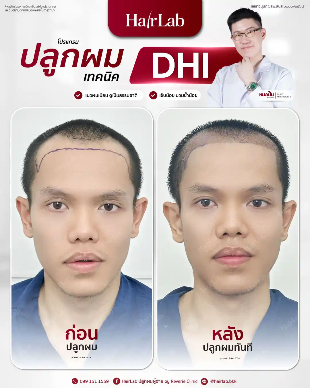 ก่อน-หลังปลูกผมเทคนิค DHI-37