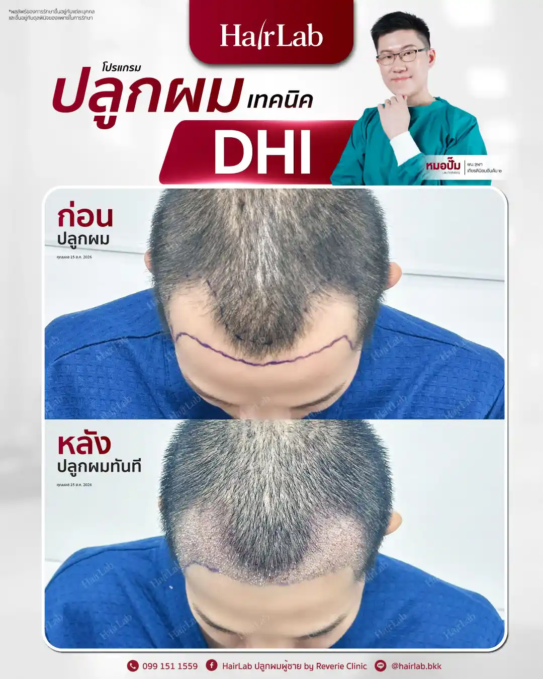 ก่อน-หลังปลูกผมเทคนิค DHI-38