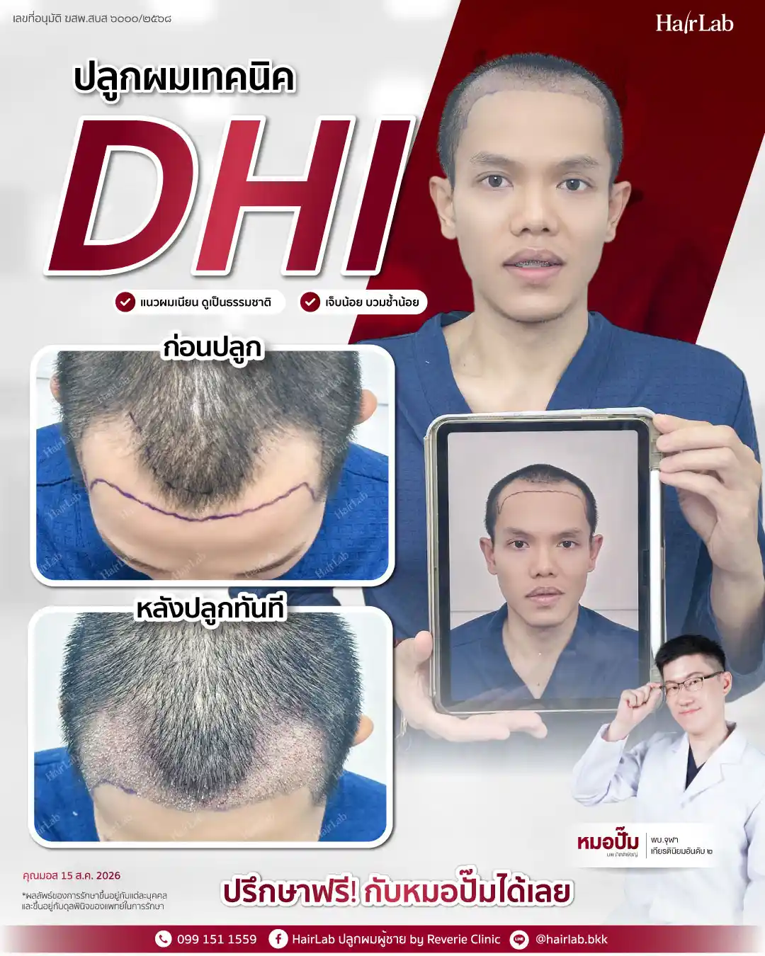 ก่อน-หลังปลูกผมเทคนิค DHI-39