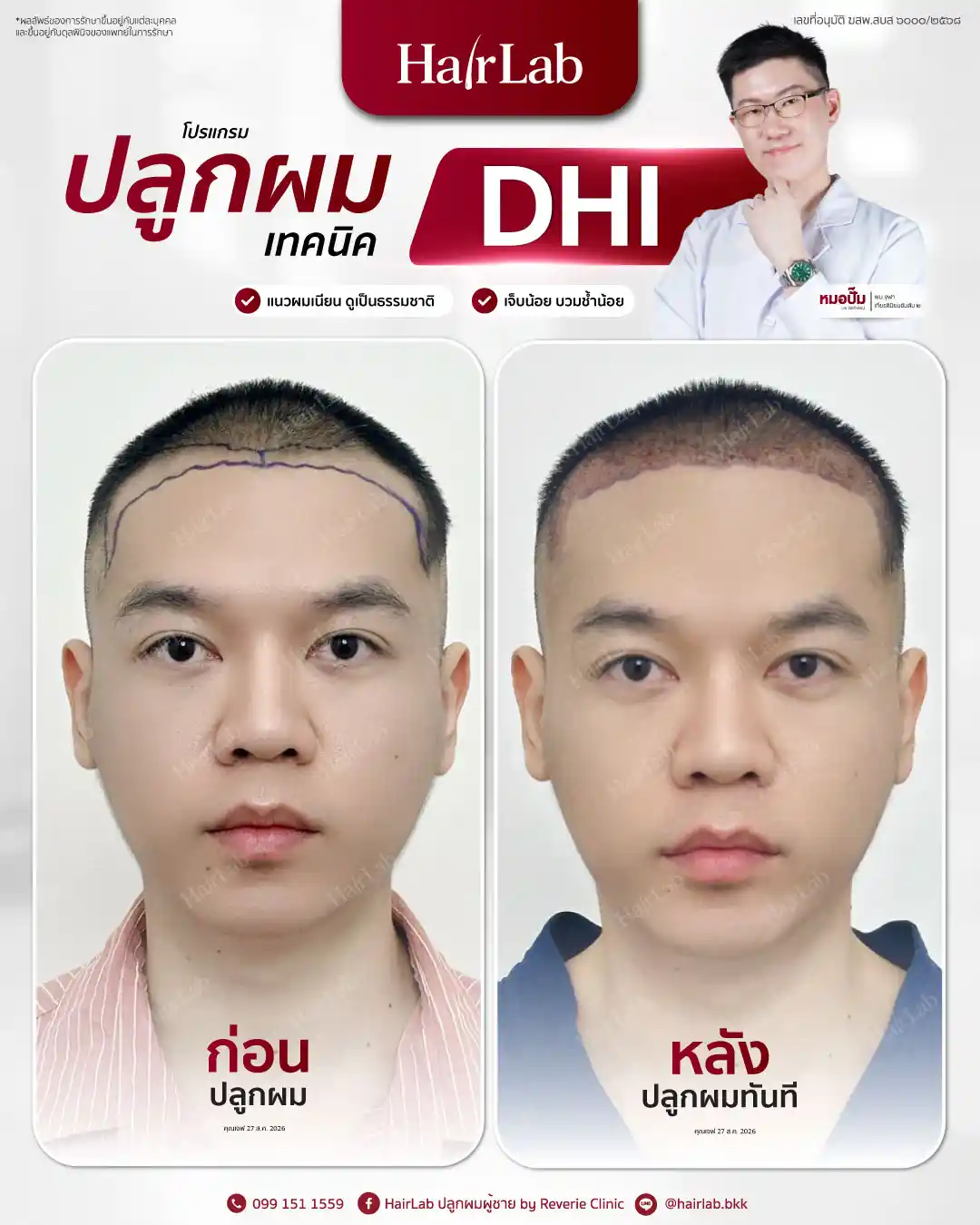 ก่อน-หลังปลูกผมเทคนิค DHI-40