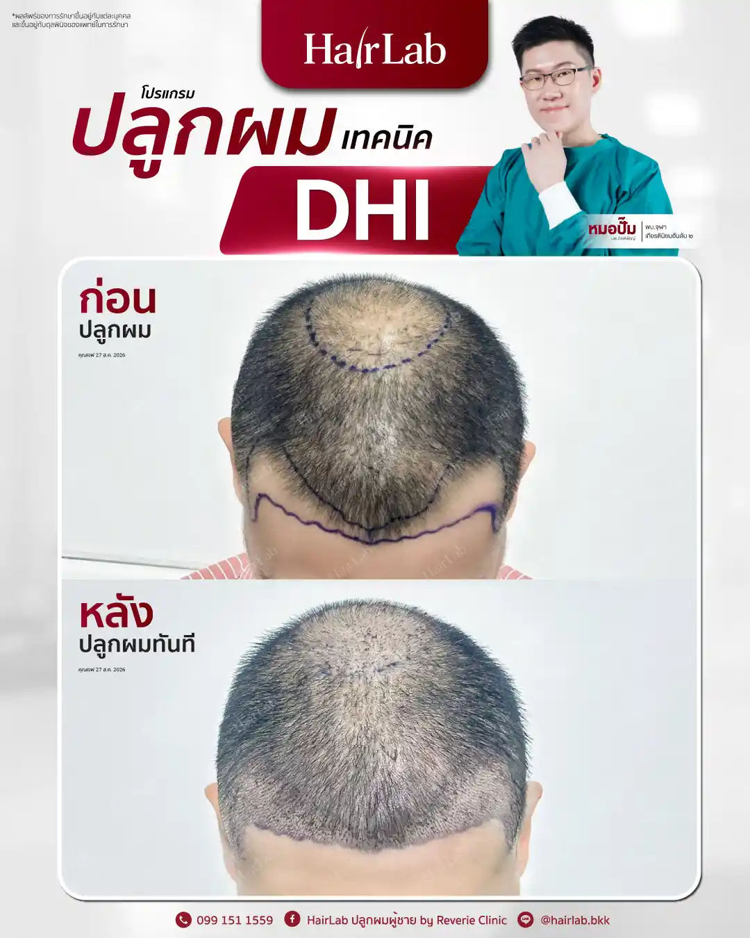 ก่อน-หลังปลูกผมเทคนิค DHI-41