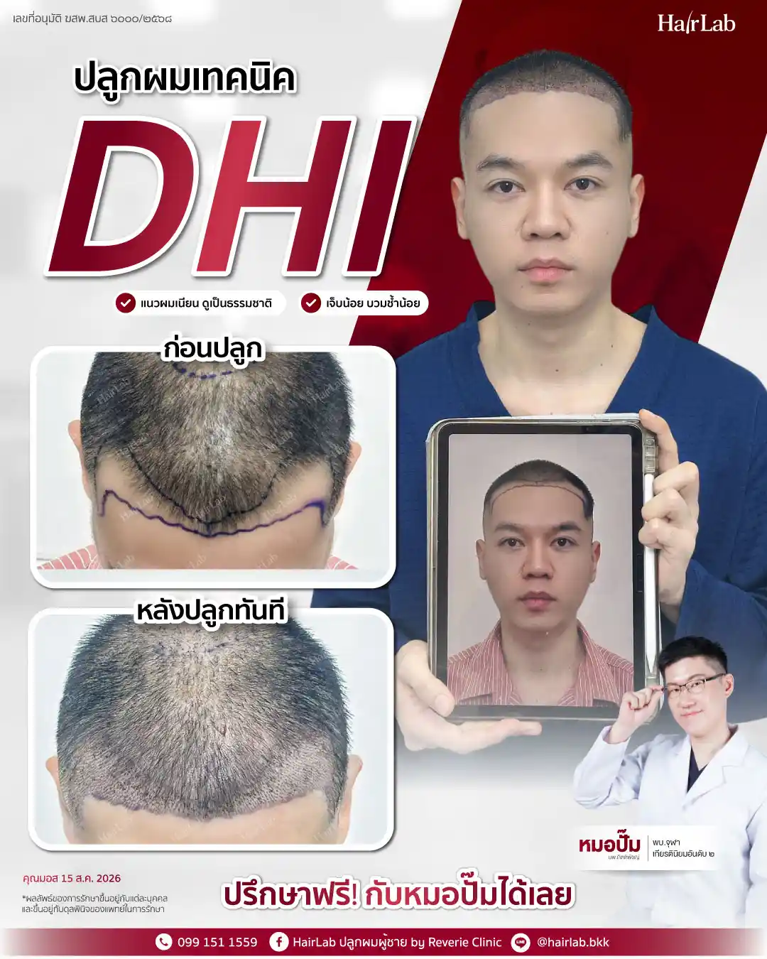 ก่อน-หลังปลูกผมเทคนิค DHI-42