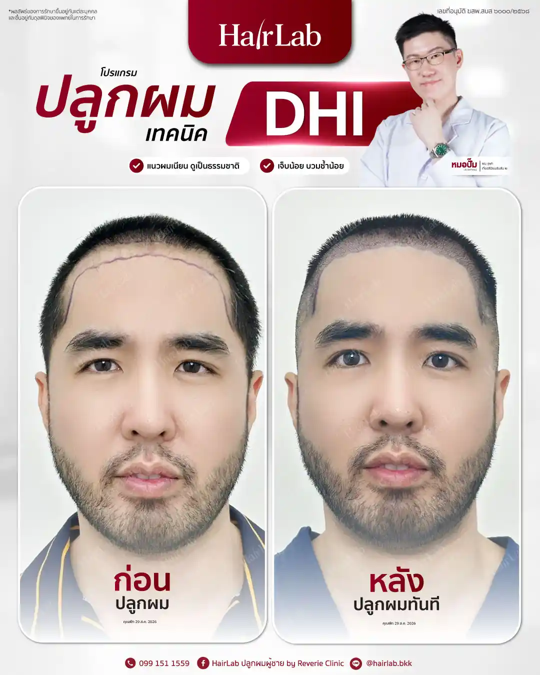 ก่อน-หลังปลูกผมเทคนิค DHI-43