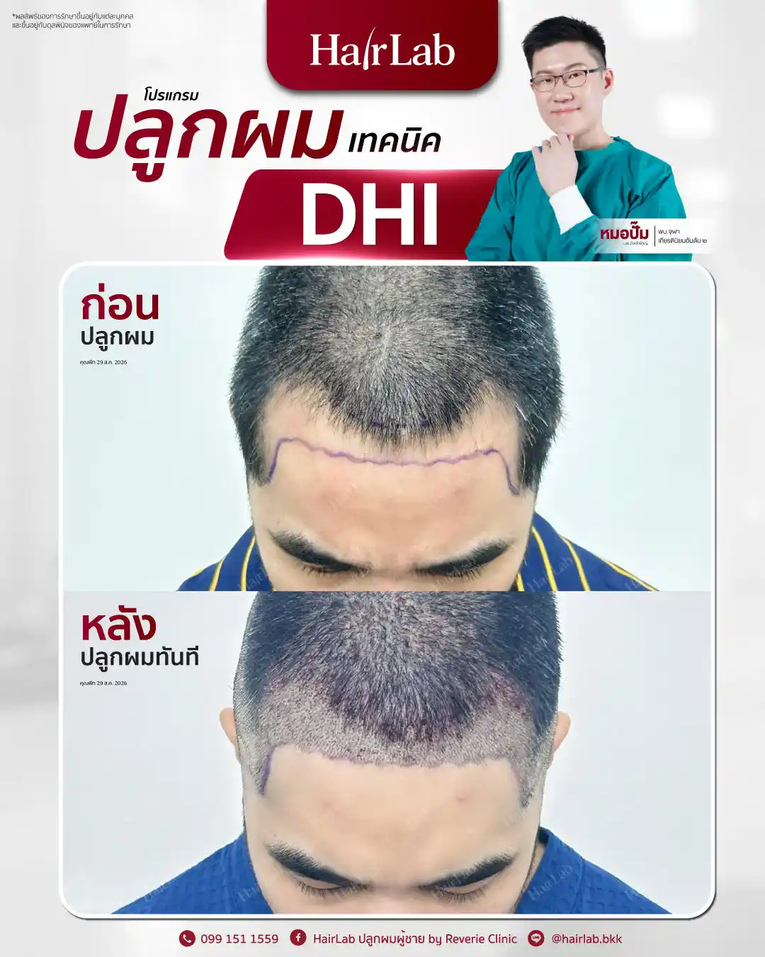ก่อน-หลังปลูกผมเทคนิค DHI-44
