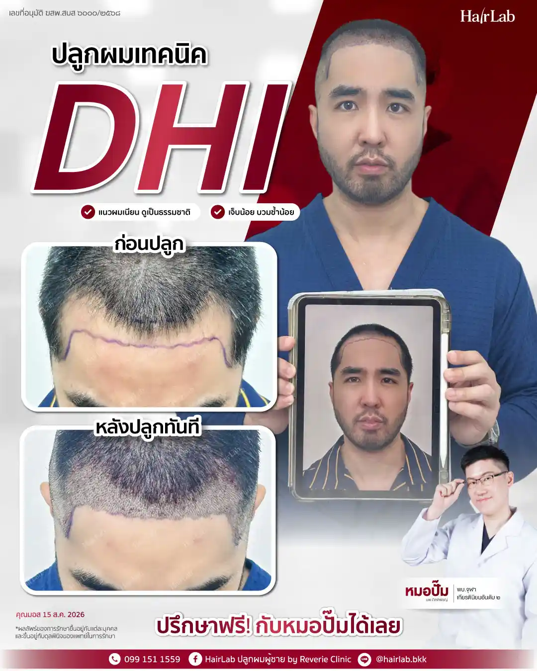 ก่อน-หลังปลูกผมเทคนิค DHI-45
