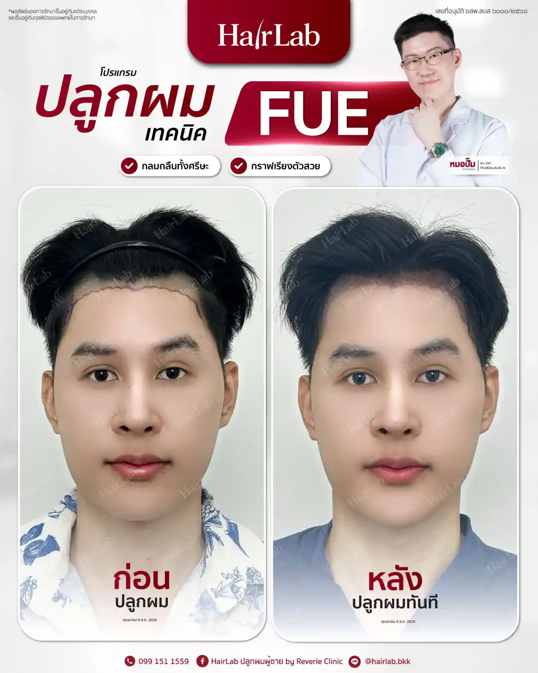 ก่อน-หลังปลูกผมเทคนิค FUE-11