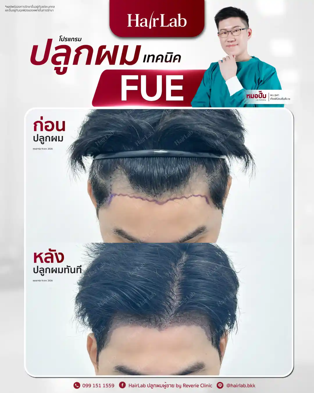 ก่อน-หลังปลูกผมเทคนิค FUE-12