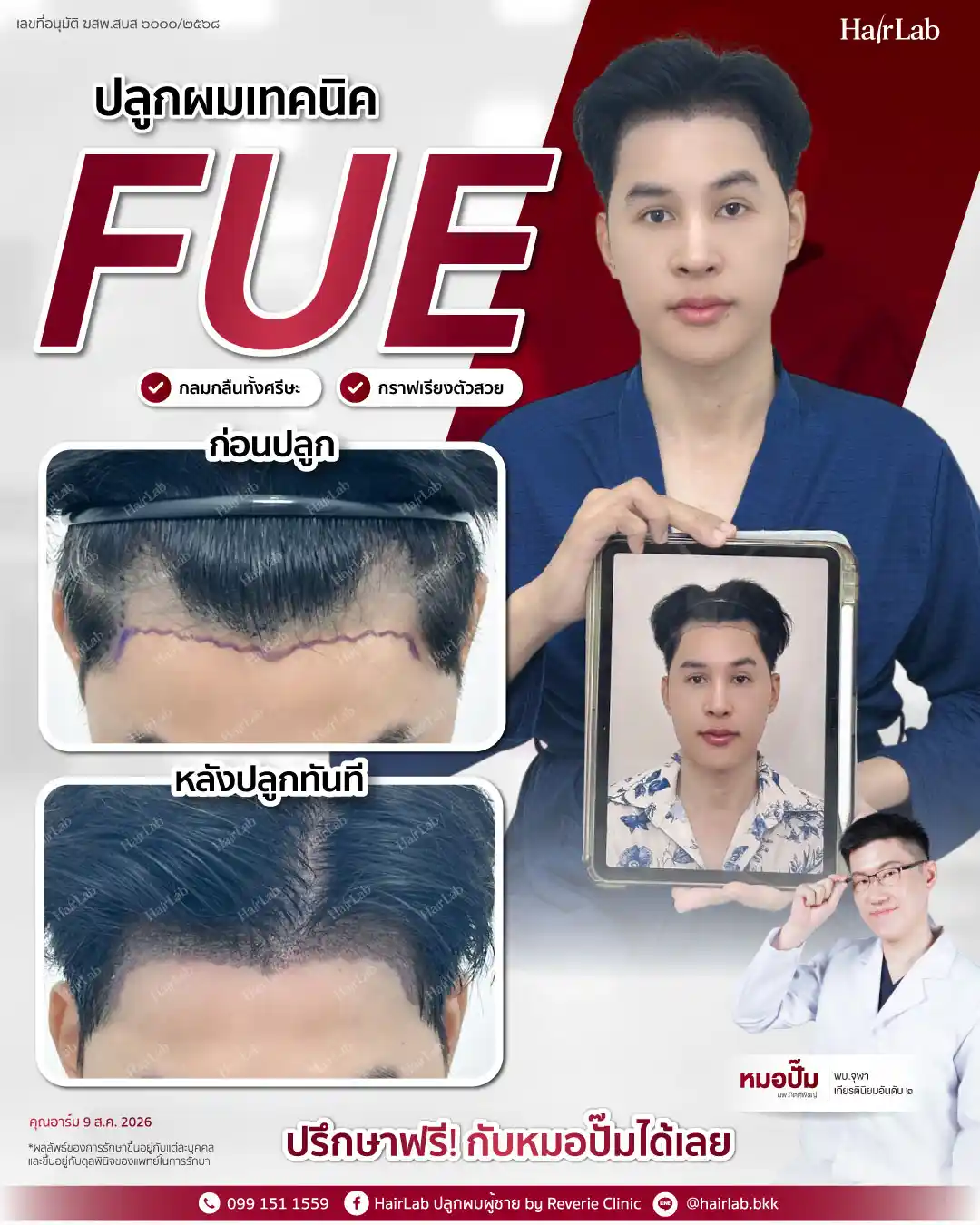 ก่อน-หลังปลูกผมเทคนิค FUE-13
