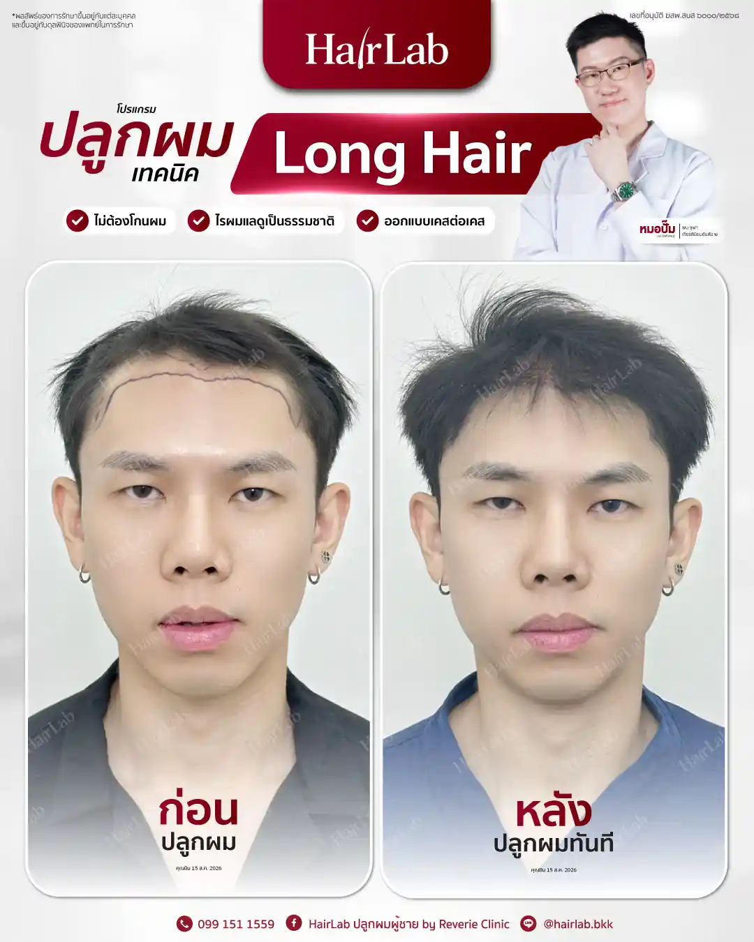 ก่อน-หลังปลูกผมเทคนิค Long Hair-30