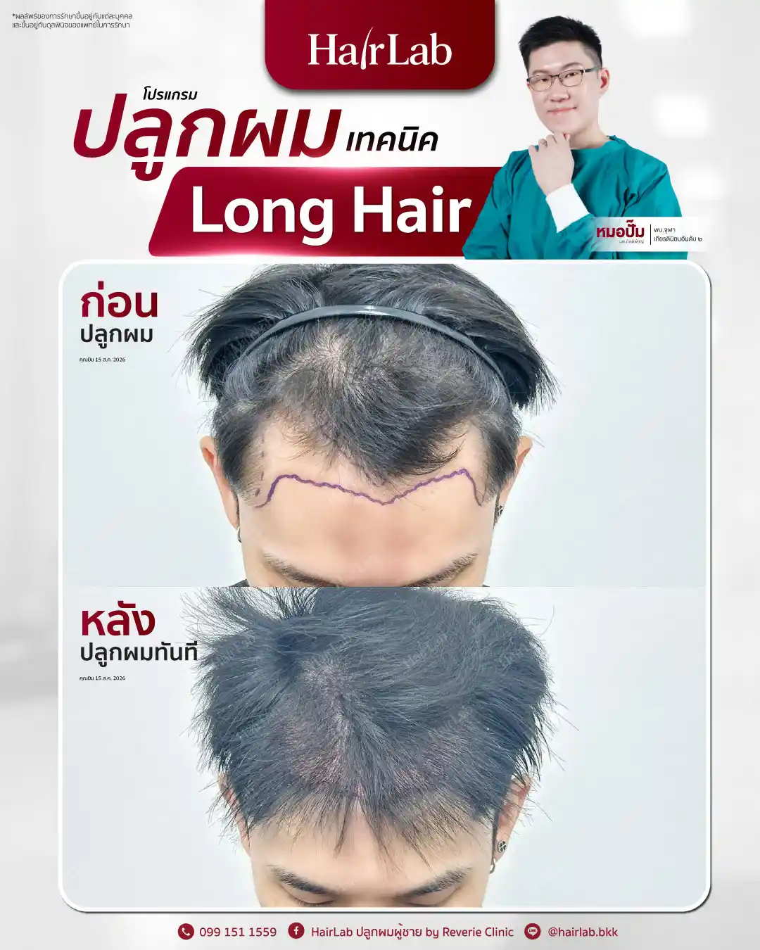 ก่อน-หลังปลูกผมเทคนิค Long Hair-31