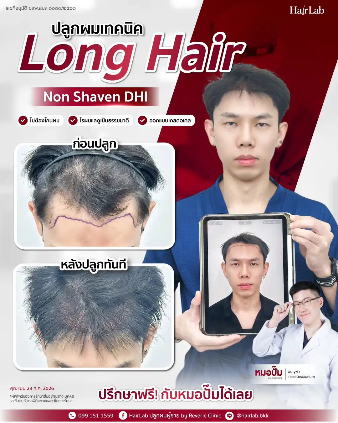 ก่อน-หลังปลูกผมเทคนิค Long Hair-32