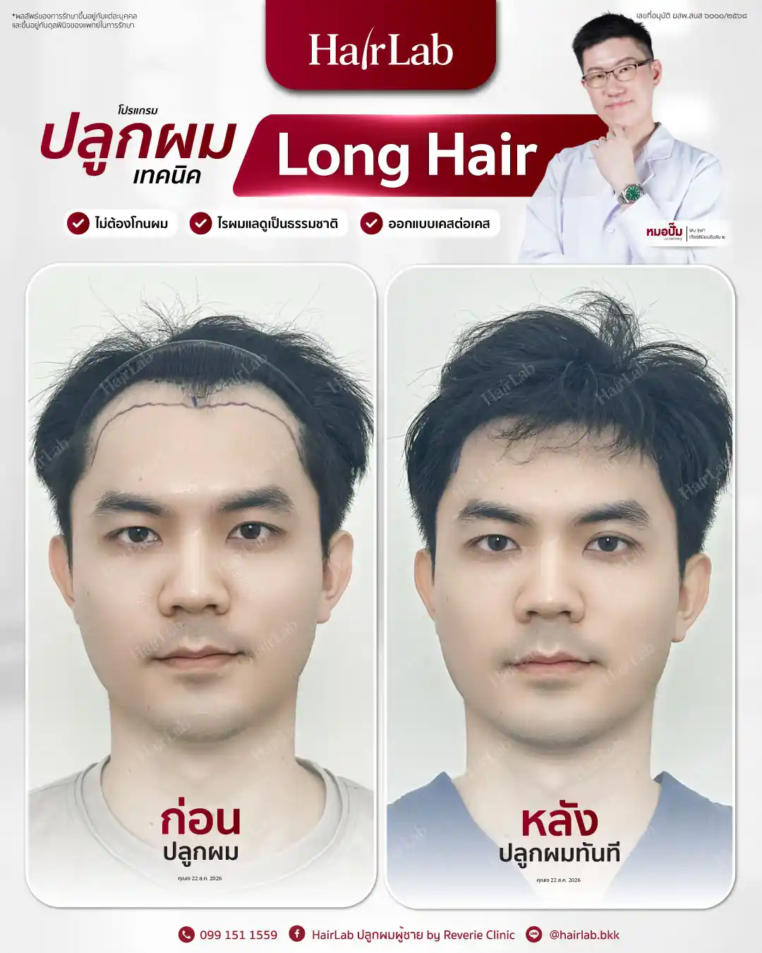 ก่อน-หลังปลูกผมเทคนิค Long Hair-33