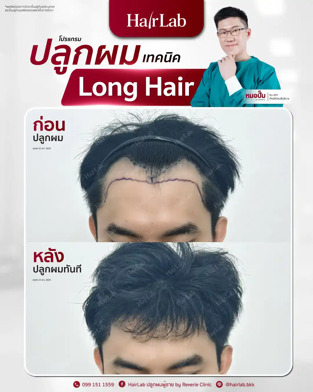 ก่อน-หลังปลูกผมเทคนิค Long Hair-34