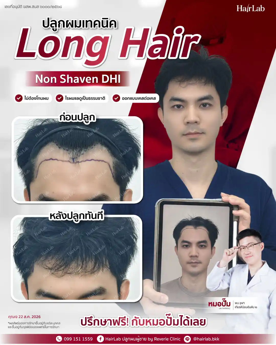 ก่อน-หลังปลูกผมเทคนิค Long Hair-35