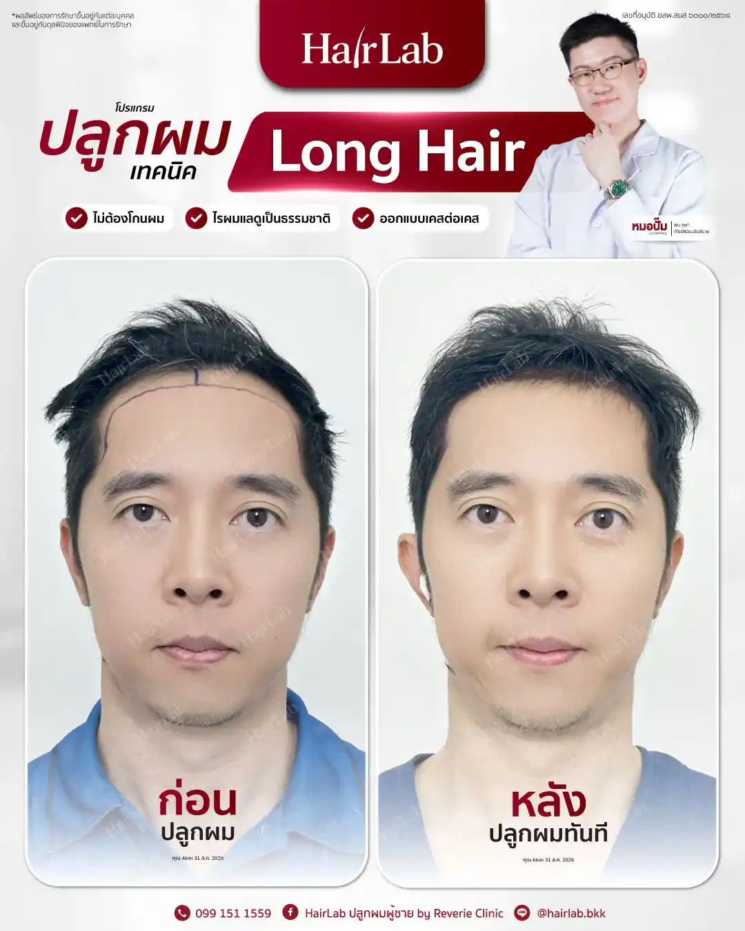 ก่อน-หลังปลูกผมเทคนิค Long Hair-36