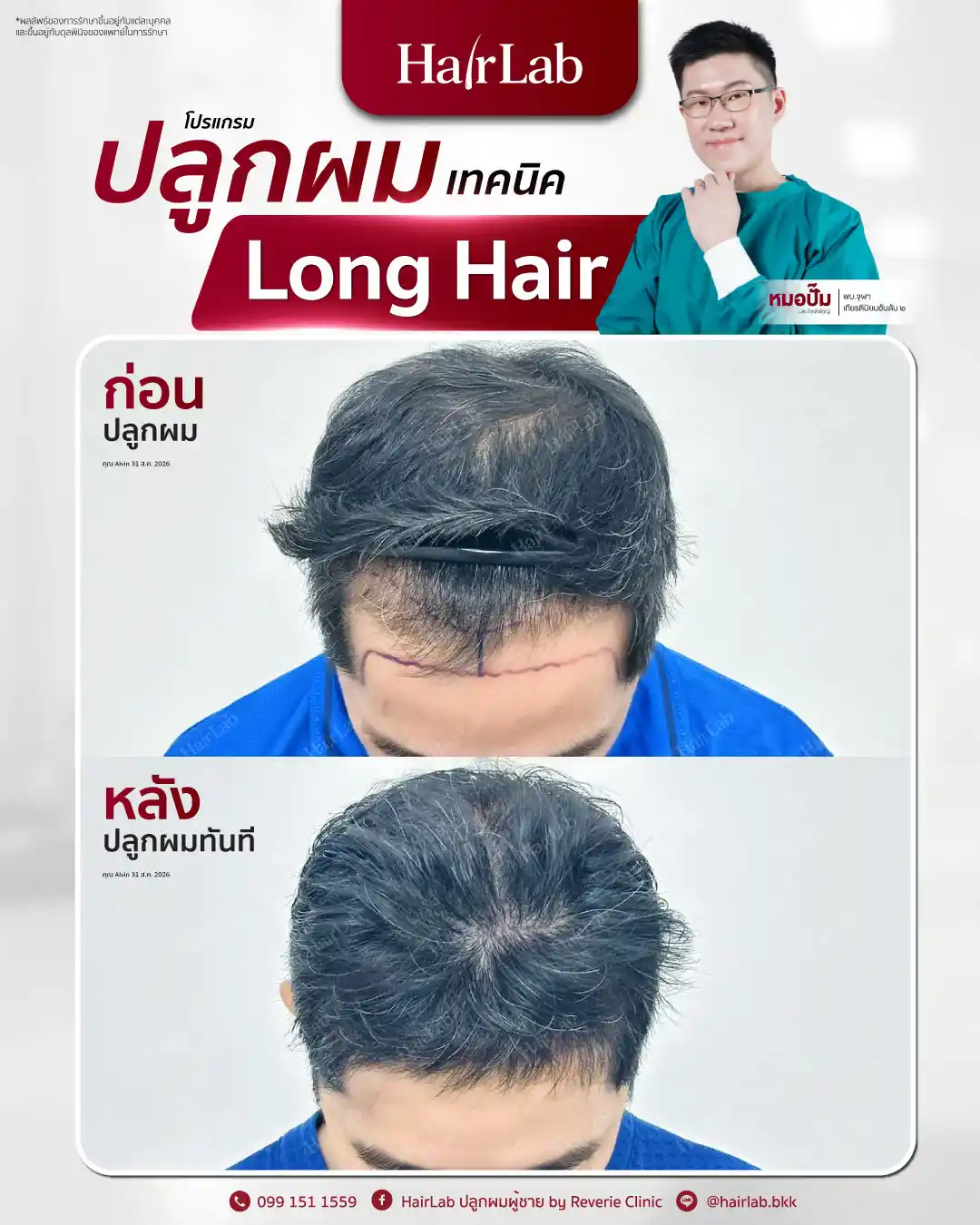 ก่อน-หลังปลูกผมเทคนิค Long Hair-37