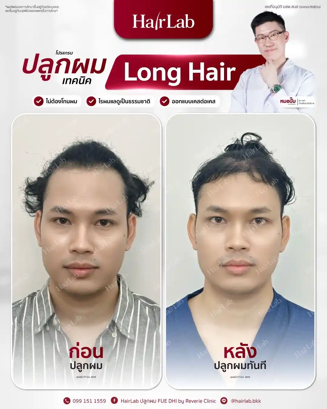 ก่อน-หลังปลูกผมเทคนิค Long Hair-38