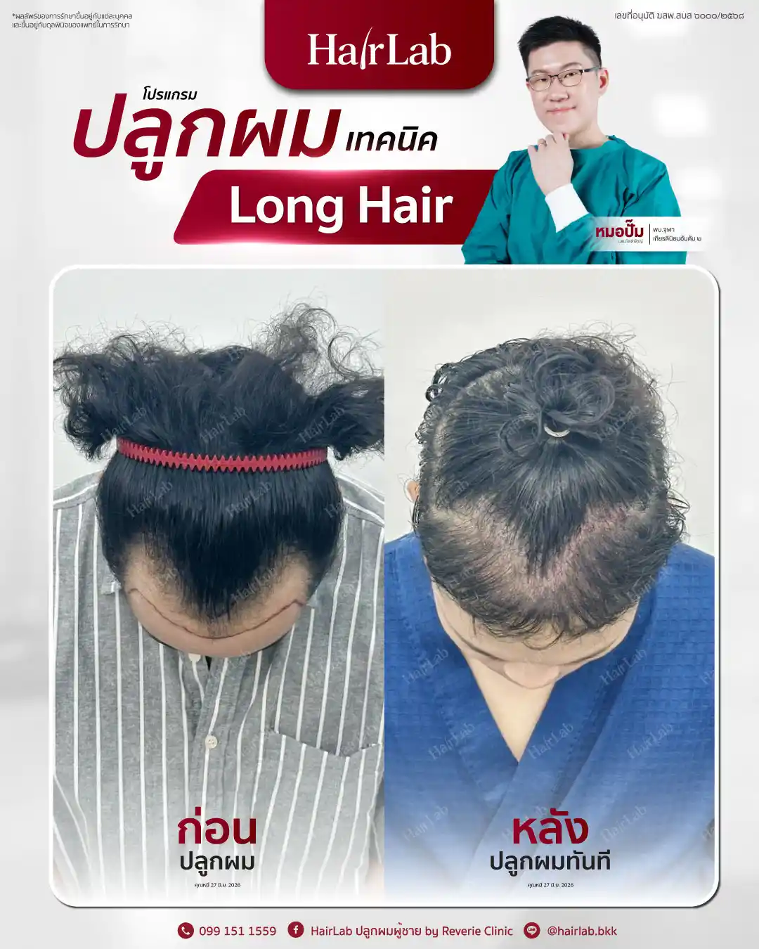 ก่อน-หลังปลูกผมเทคนิค Long Hair-39