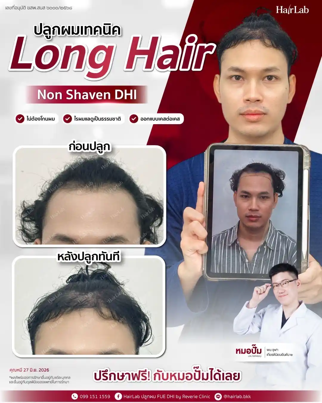ก่อน-หลังปลูกผมเทคนิค Long Hair-40